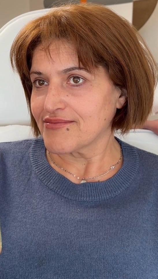 Patientin nach ästhetischer Behandlung mit frischerem Ausdruck
